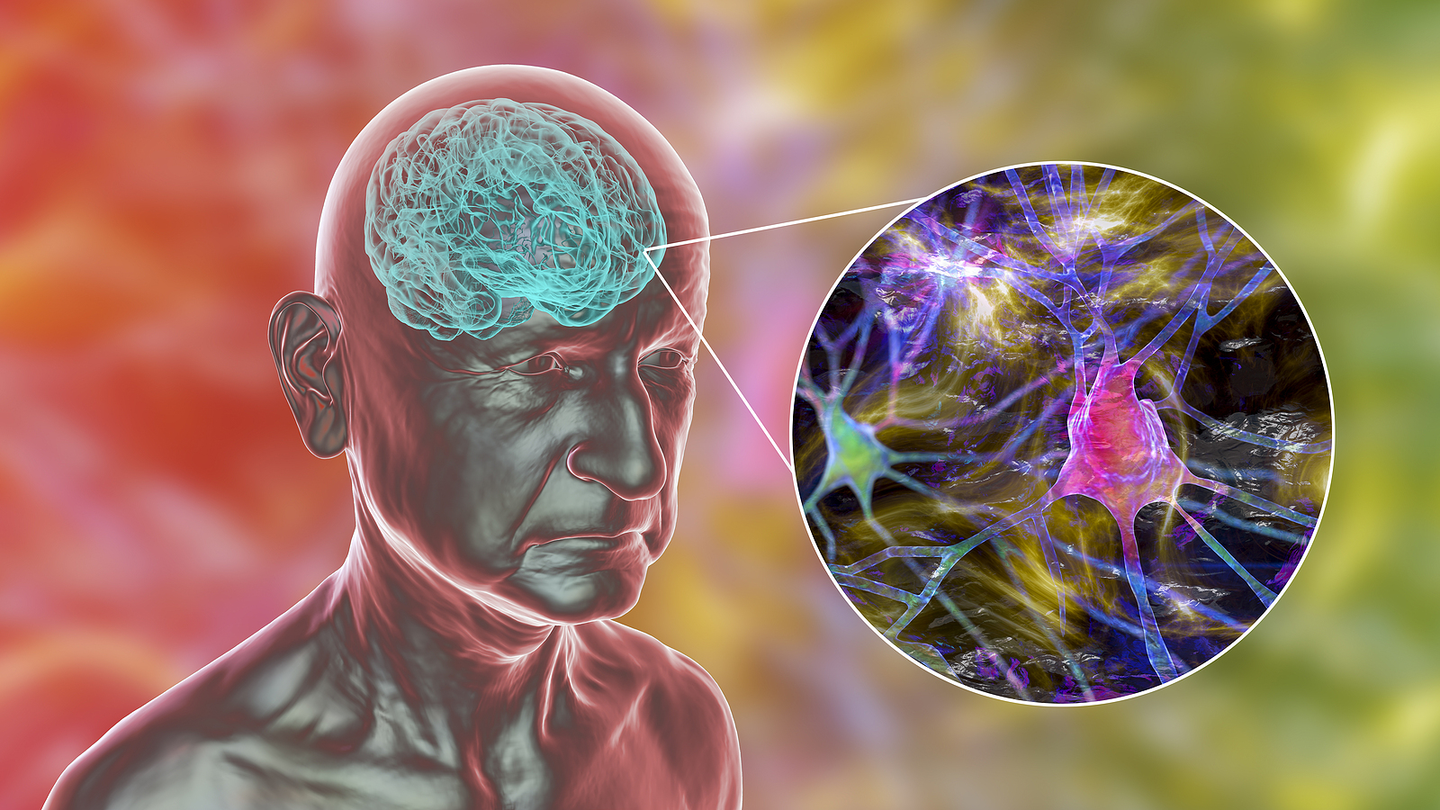 What Is Frontotemporal Dementia And What Are The Symptoms?